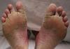 Behandlung von Fußpilznägeln, dick schwarz