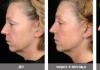 A long-proven, effective, but expensive Thermage procedure for the face and body