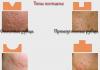 Keloid Scars Gesichtsmaske für Aknenarben