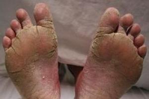 Atleto pėdų nagų gydymas, storas juodas